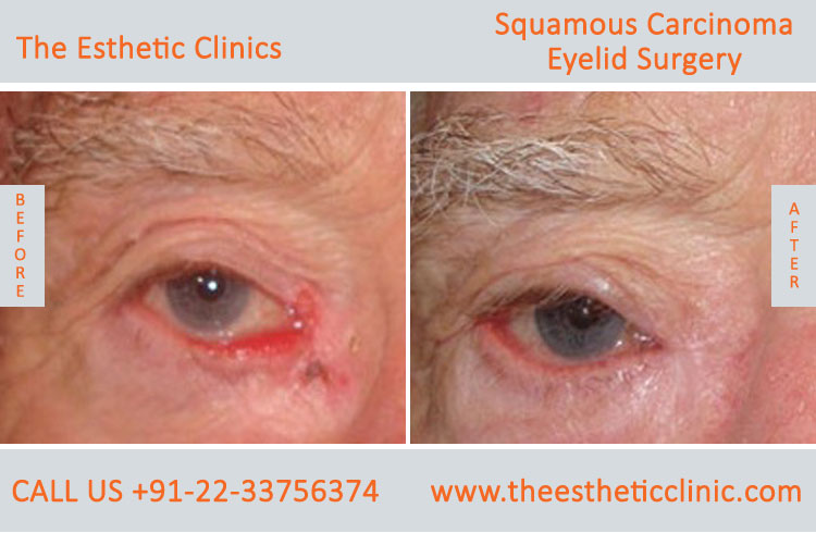Sebaceous Carcinoma of Eyelid Surgery before after photos in mumbai india (3)